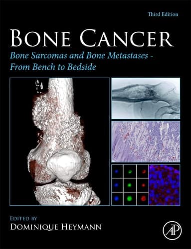 Bone Cancer Bone Sarcomas and Bone Metastases - From Bench to Bedside