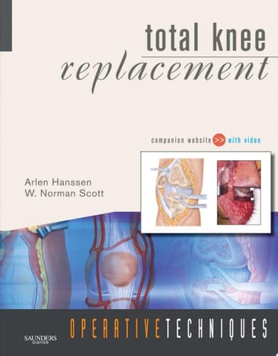 Total Knee Replacement
