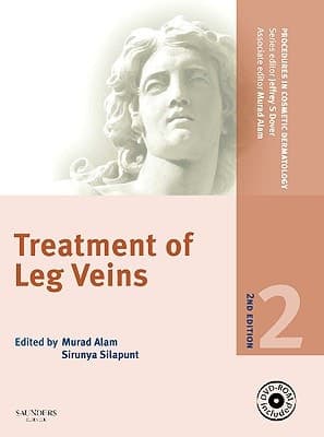 Treatment of Leg Veins