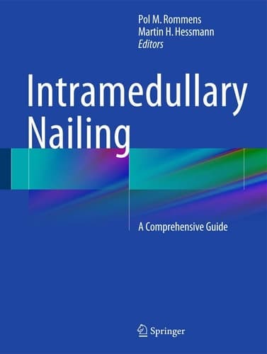 Intramedullary Nailing A Comprehensive Guide