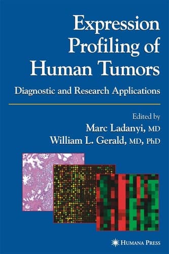 Expression Profiling of Human Tumors Diagnostic and Research Applications