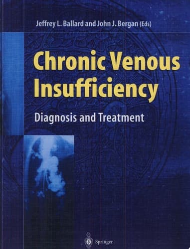 Chronic Venous Insufficiency Diagnosis and Treatment