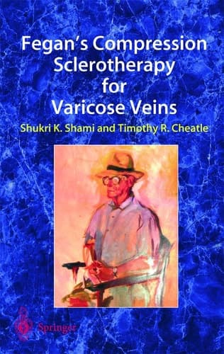 Fegan’s Compression Sclerotherapy for Varicose Veins