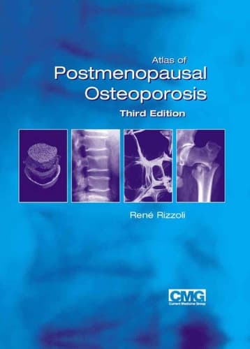 Atlas of Postmenopausal Osteoporosis Third Edition
