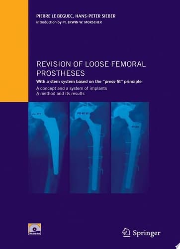 Revision of loose femoral prostheses with a stem system based on the "press-fit" principle A Concept and Its System of Implants, a Method and Its Results