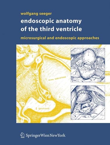 Endoscopic Anatomy of the Third Ventricle Microsurgical and Endoscopic Approaches