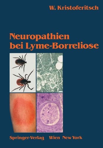 Neuropathien Bei Lyme-Borreliose