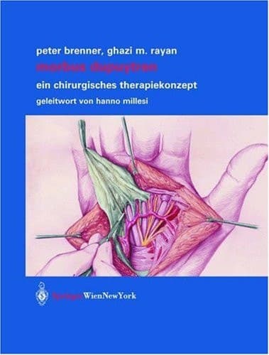 Morbus Dupuytren Ein chirurgisches Therapiekonzept