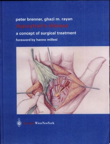 Dupuytren’s Disease A Concept of Surgical Treatment