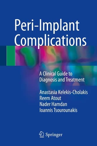Peri-Implant Complications A Clinical Guide to Diagnosis and Treatment