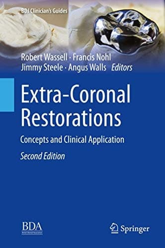 Extra-Coronal Restorations Concepts and Clinical Application