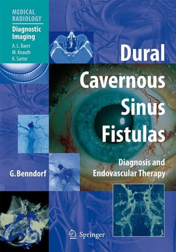 Dural Cavernous Sinus Fistulas Diagnosis and Endovascular Therapy