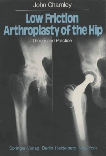 Low Friction Arthroplasty of the Hip Theory and Practice