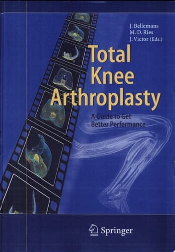 Total Knee Arthroplasty A Guide To Get Better Performance