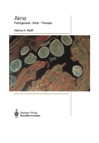 Akne Pathogenese — Klinik — Therapie