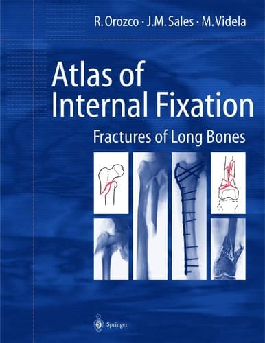 Atlas of Internal Fixation Fractures of Long Bones : Classification, Statistical Analysis, Technique, Radiology