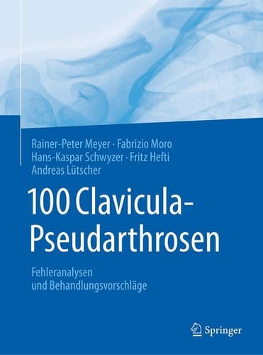 100 Clavicula-Pseudarthrosen Fehleranalysen und Behandlungsvorschläge