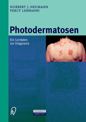 Photodermatosen Ein Leitfaden zur Diagnostik