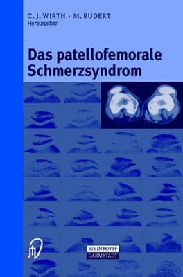 Das patellofemorale Schmerzsyndrom