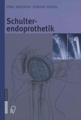 Schulterendoprothetik Indikation, Implantate, OP-Technik, Nachbehandlung, Begutachtung ; mit 57 Tabellen