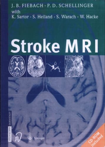 Stroke MRI