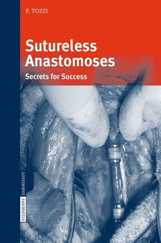 Sutureless Anastomoses Secrets for Success