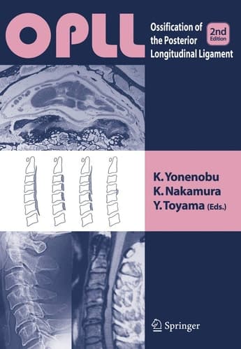 OPLL Ossification of the Posterior Longitudinal Ligament